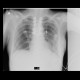 Rupture of the diaphragm, diaphragmatic hernia: X-ray - Plain radiograph